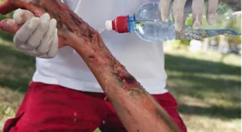 Comment réagir à une brulure selon la Wilderness Medicine? Last Guide