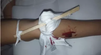 Comment faire un garrot de fortune? Last Guide