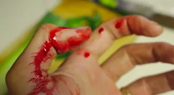 Comment réagir à un hématomes, écrasements et morsures selon la Wilderness Medicine? Last Guide 