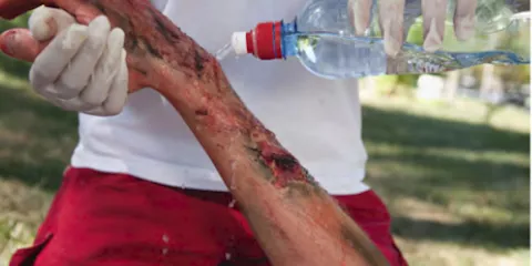 Comment réagir à une brulure selon la Wilderness Medicine? Last Guide