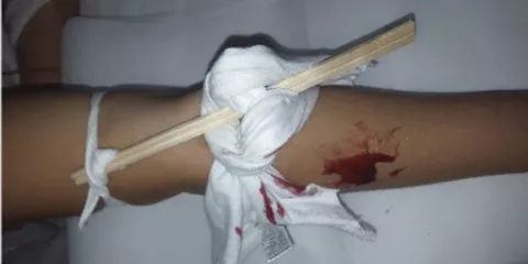 Comment faire un garrot de fortune? Last Guide