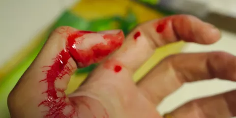 Comment réagir à un hématomes, écrasements et morsures selon la Wilderness Medicine? Last Guide 