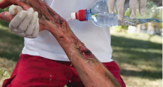 Comment réagir à une brulure selon la Wilderness Medicine? Last Guide