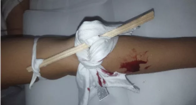 Comment faire un garrot de fortune? Last Guide