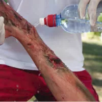 Comment réagir à une brulure selon la Wilderness Medicine? Last Guide