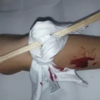 Comment faire un garrot de fortune? Last Guide